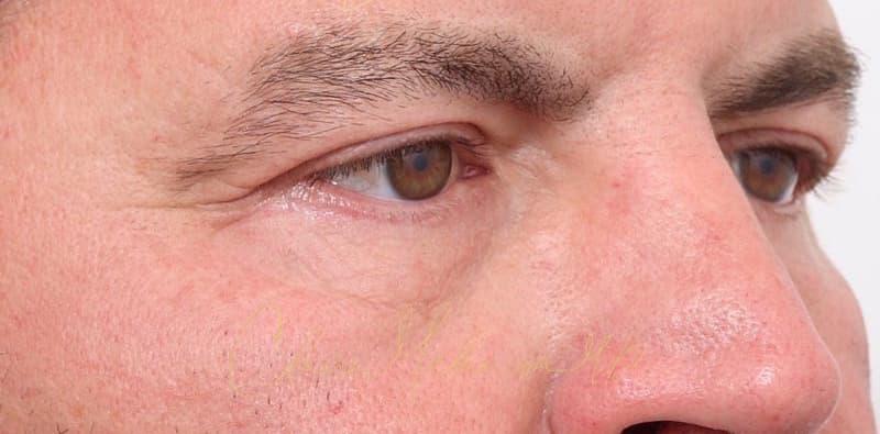 Blepharoplasty Before & After Photo