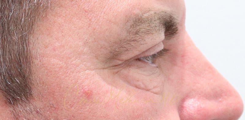 Blepharoplasty Before & After Photo