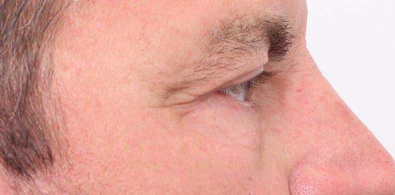 Blepharoplasty Before & After Photo