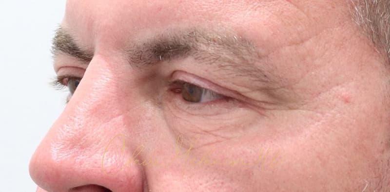 Blepharoplasty Before & After Photo