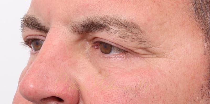 Blepharoplasty Before & After Photo