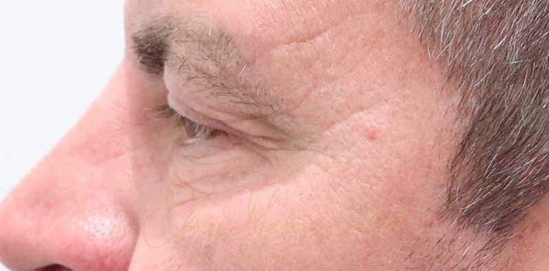 Blepharoplasty Before & After Photo