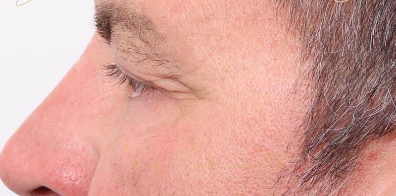 Blepharoplasty Before & After Photo