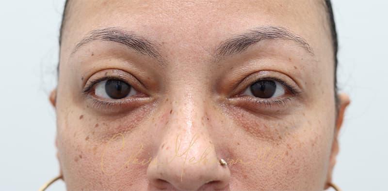 Blepharoplasty Before & After Photo