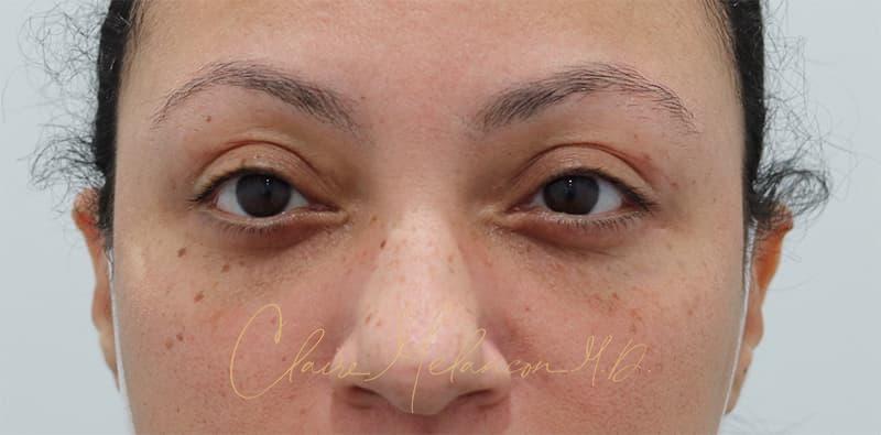 Blepharoplasty Before & After Photo