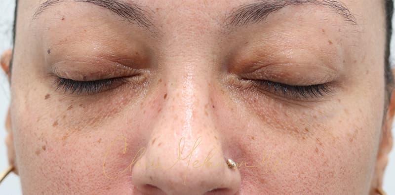 Blepharoplasty Before & After Photo