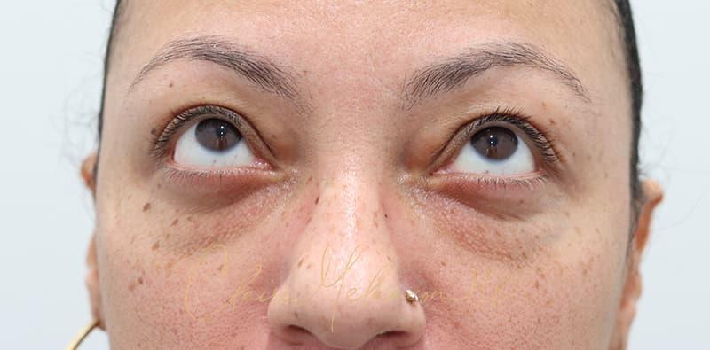 Blepharoplasty Before & After Photo