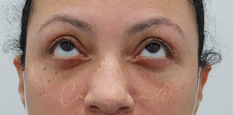 Blepharoplasty Before & After Photo