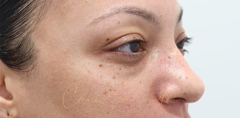 Blepharoplasty Before & After Photo