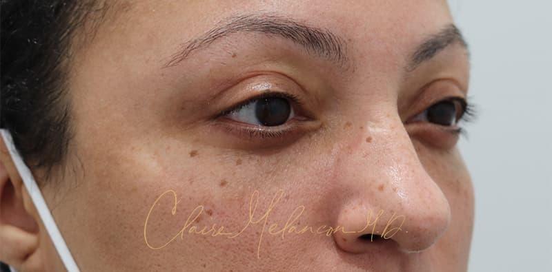 Blepharoplasty Before & After Photo