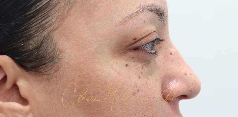 Blepharoplasty Before & After Photo