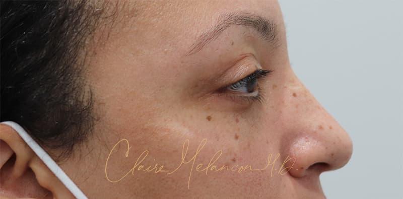 Blepharoplasty Before & After Photo