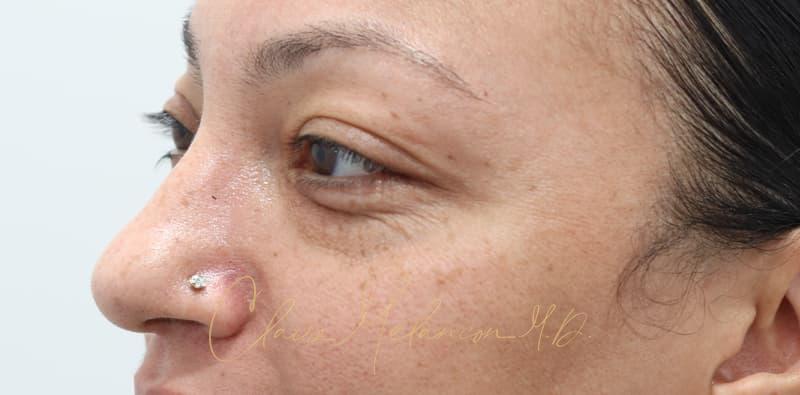 Blepharoplasty Before & After Photo