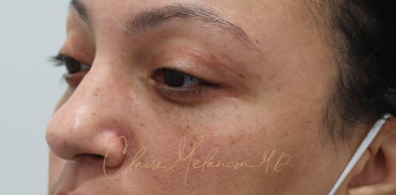 Blepharoplasty Before & After Photo