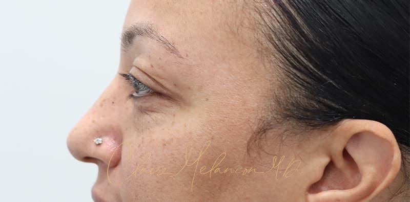 Blepharoplasty Before & After Photo