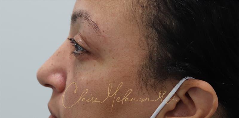 Blepharoplasty Before & After Photo