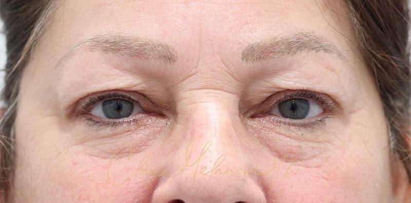 Blepharoplasty Before & After Photo