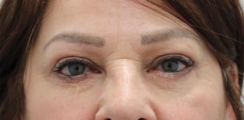 Blepharoplasty Before & After Photo