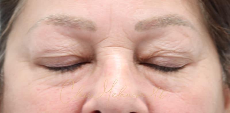 Blepharoplasty Before & After Photo
