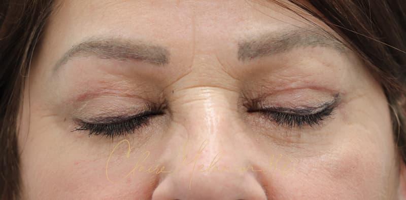 Blepharoplasty Before & After Photo