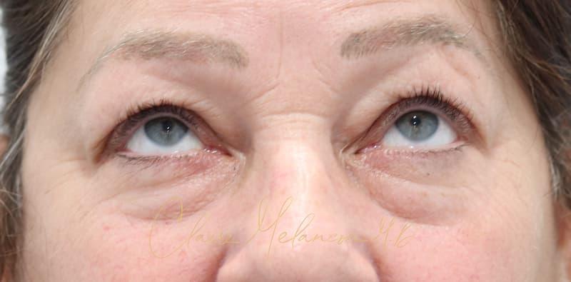 Blepharoplasty Before & After Photo