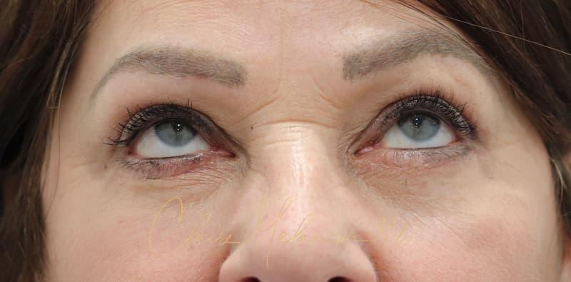 Blepharoplasty Before & After Photo
