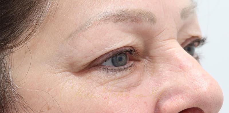 Blepharoplasty Before & After Photo