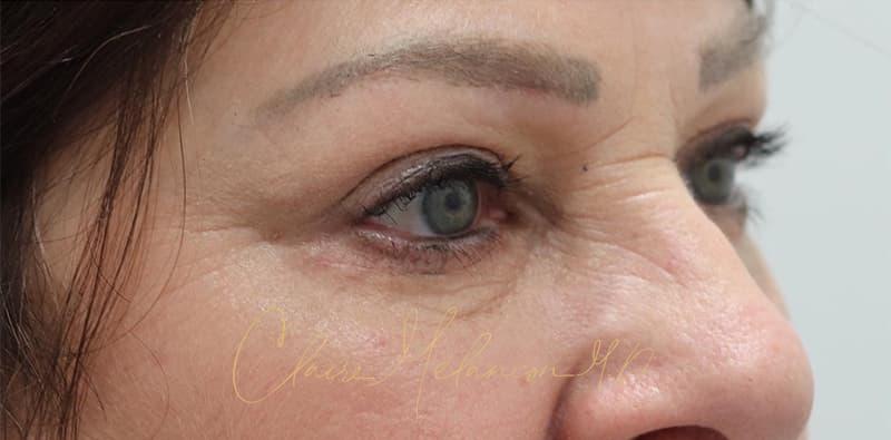 Blepharoplasty Before & After Photo