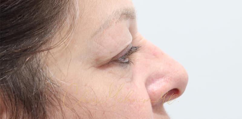 Blepharoplasty Before & After Photo