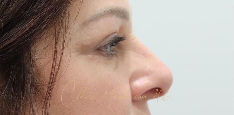 Blepharoplasty Before & After Photo