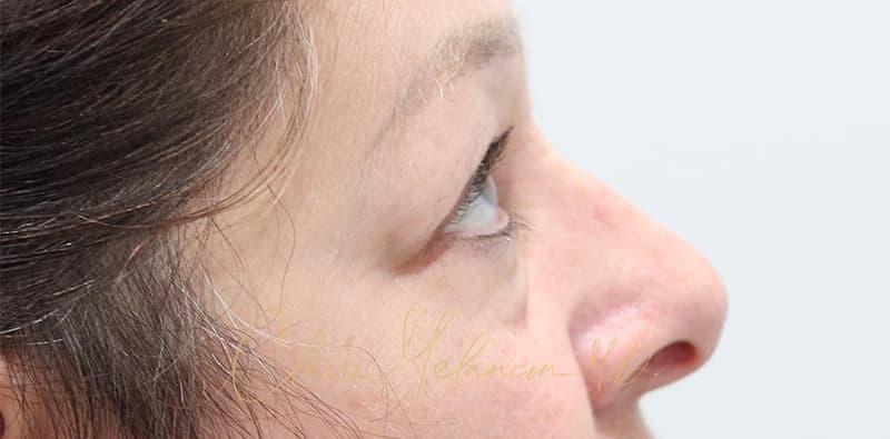 Blepharoplasty Before & After Photo
