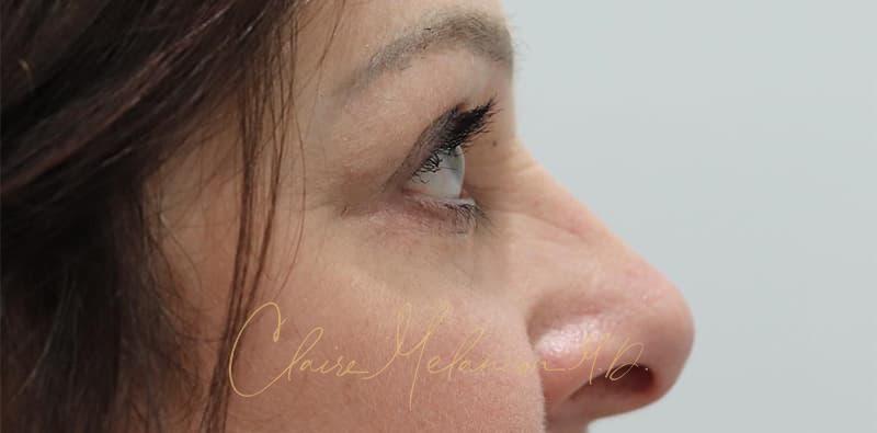 Blepharoplasty Before & After Photo