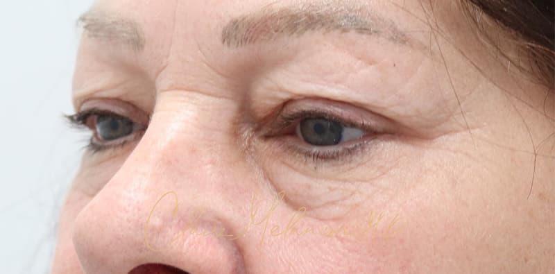 Blepharoplasty Before & After Photo