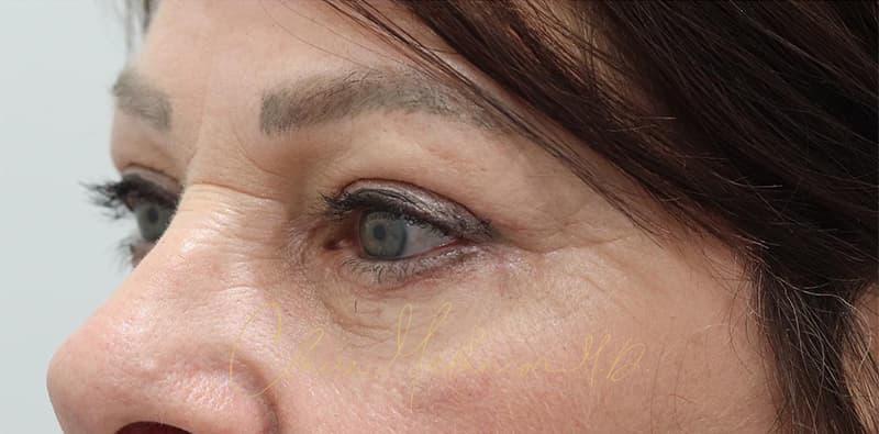 Blepharoplasty Before & After Photo
