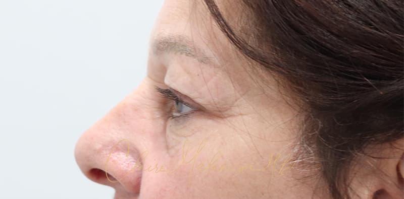 Blepharoplasty Before & After Photo