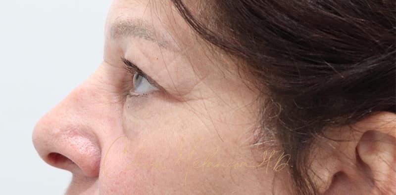 Blepharoplasty Before & After Photo