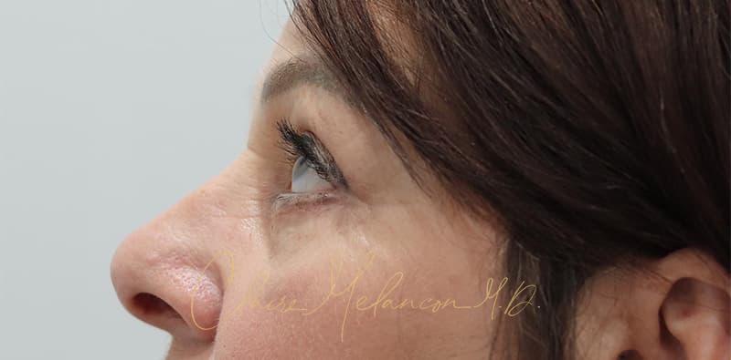 Blepharoplasty Before & After Photo