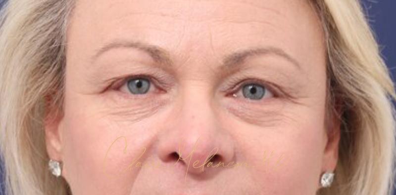 Blepharoplasty Before & After Photo