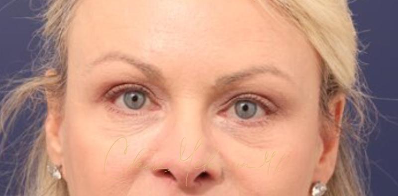 Blepharoplasty Before & After Photo