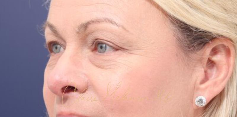 Blepharoplasty Before & After Photo