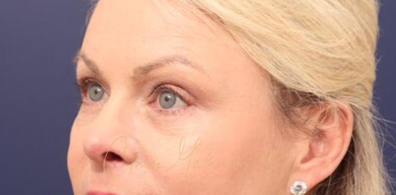 Blepharoplasty Before & After Photo
