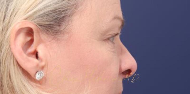 Blepharoplasty Before & After Photo