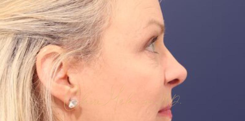 Blepharoplasty Before & After Photo