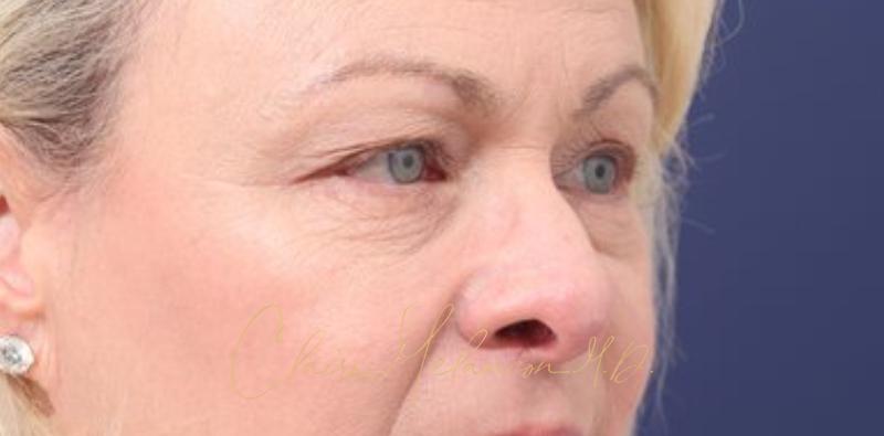 Blepharoplasty Before & After Photo
