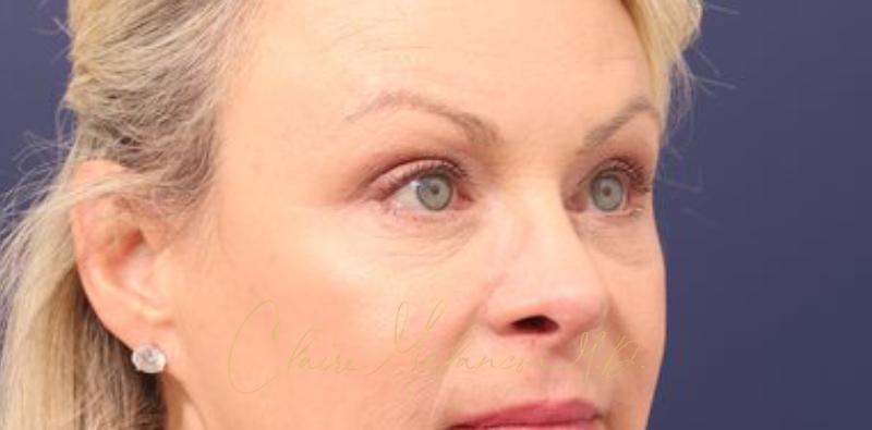 Blepharoplasty Before & After Photo