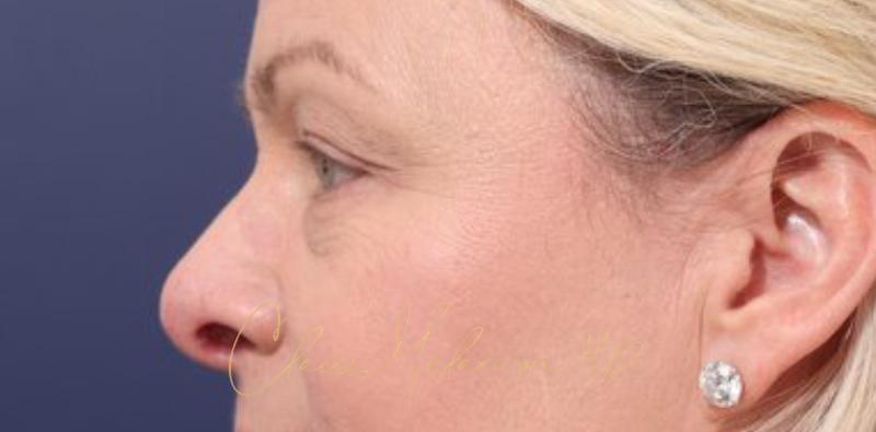 Blepharoplasty Before & After Photo