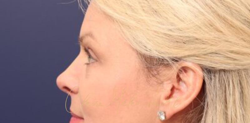Blepharoplasty Before & After Photo