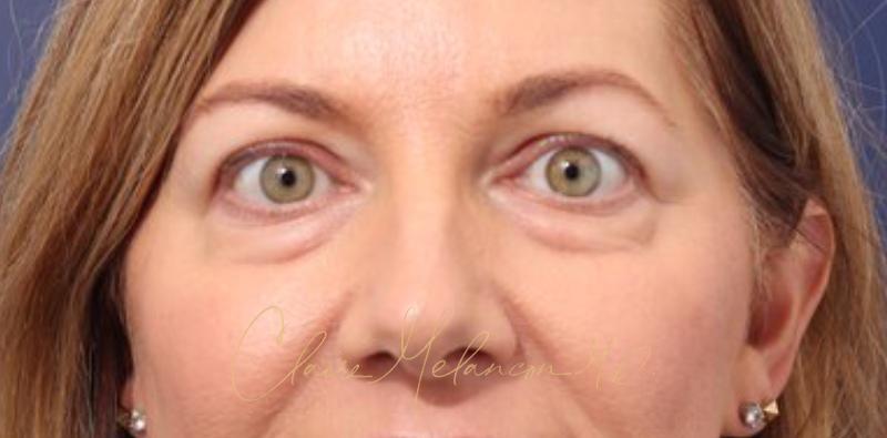 Blepharoplasty Before & After Photo