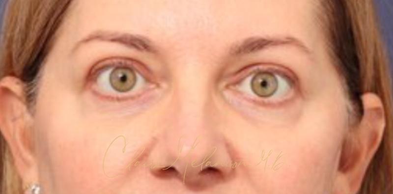 Blepharoplasty Before & After Photo