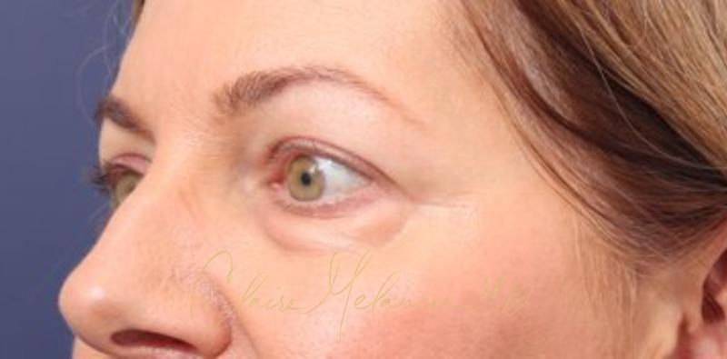 Blepharoplasty Before & After Photo